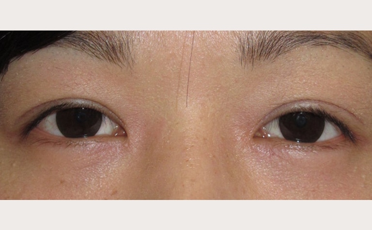 目頭切開（V-Y法）＋眼瞼下垂手術後